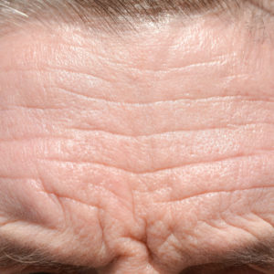 forehead wrinkles