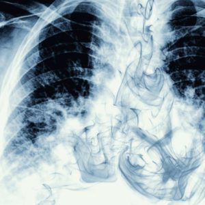 chest xray